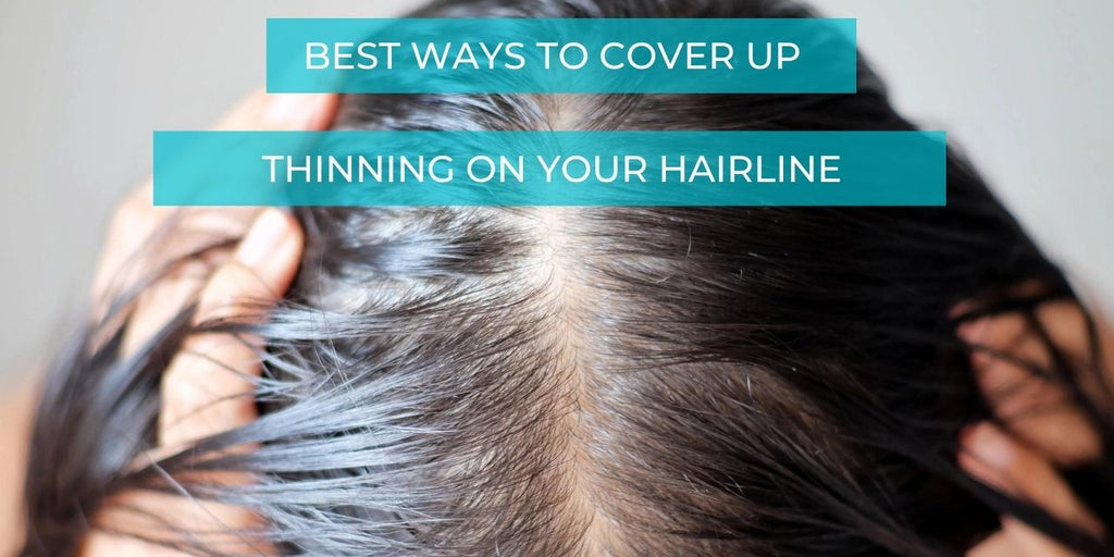 Hair Loss on Your Hairline
